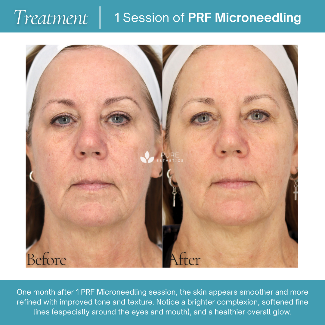 Before-and-after treatment results show the visible outcome of one session of PRF microneedling.