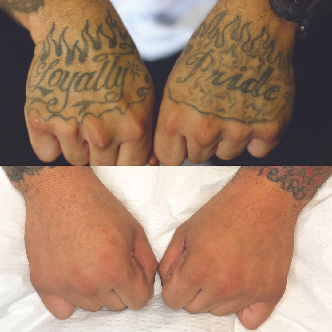 Removery Tattoo Removal & Fading à Ottawa: Before & After Hand Tattoo Removal