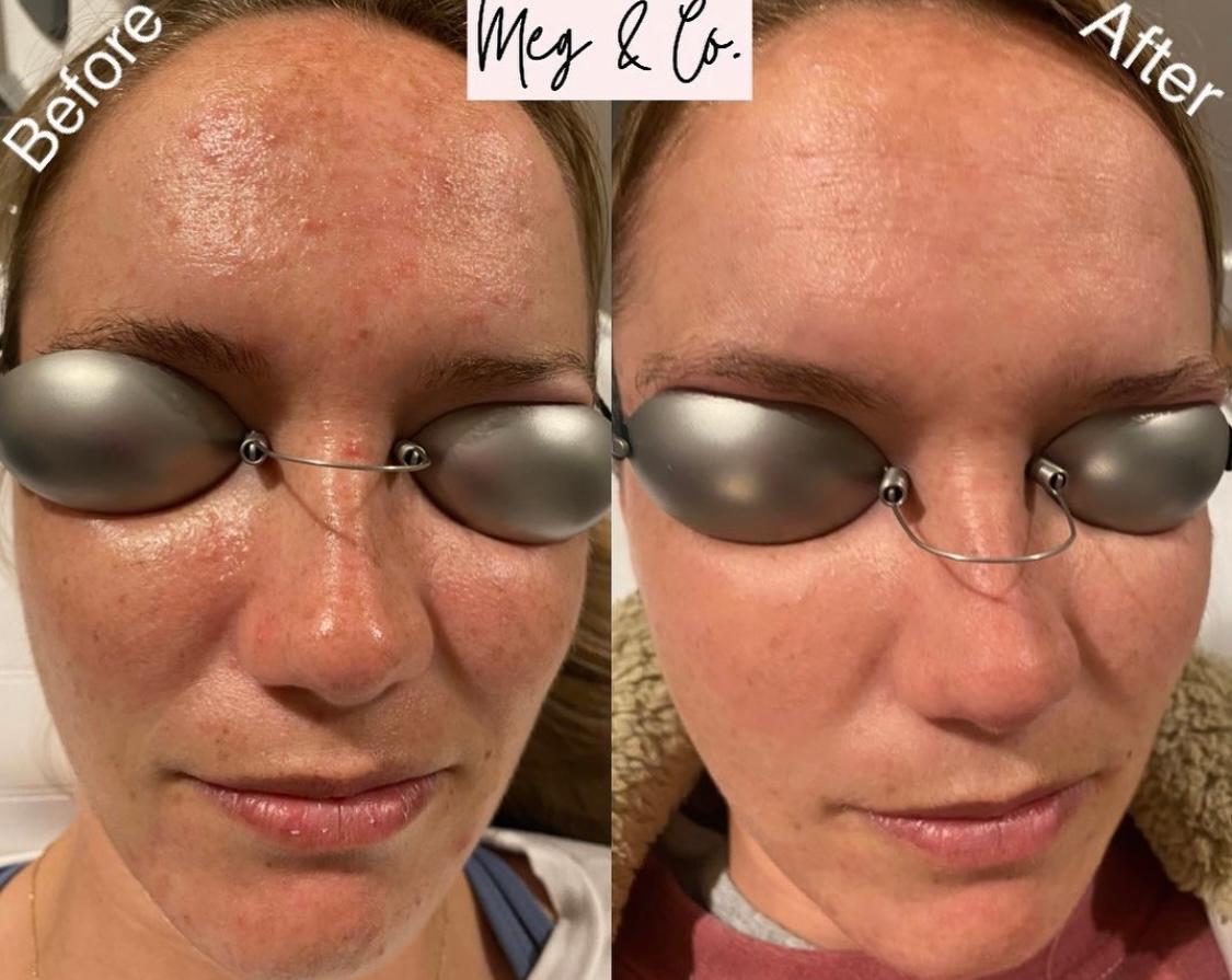 Before and After One LaseMD Ultra Treatment