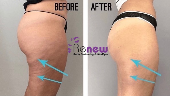 Images Renew Body Contouring & MedSpa