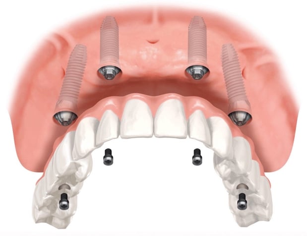 Images Progressive Periodontics and Implant Dentistry
