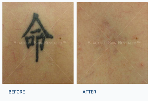 Before and After | Tattoo Removal at Dermatology & Laser Surgery Center
