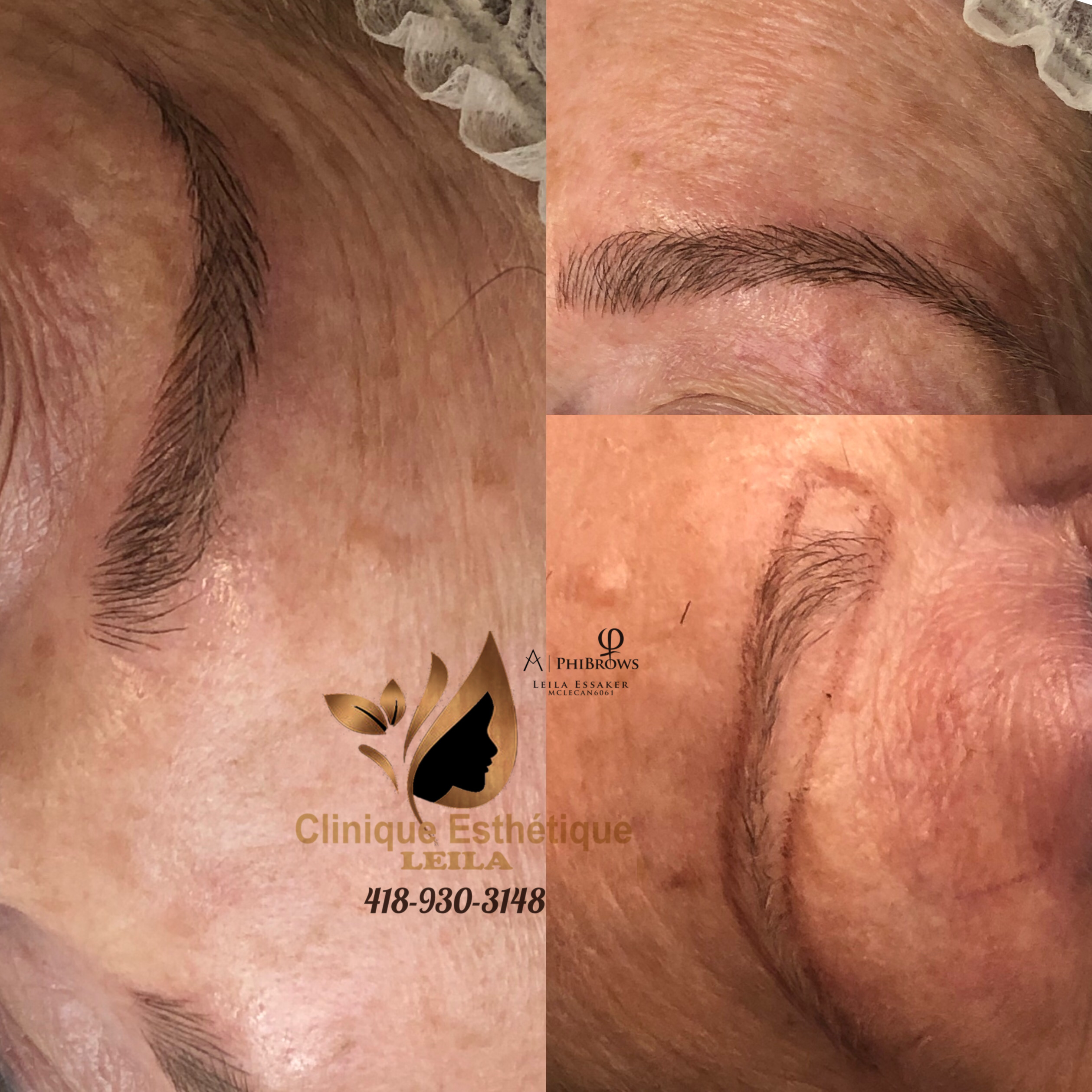 Images Clinique d'Esthétique Leila - Hydrafacial, Microblading, Épilation Laser Sainte-Foy