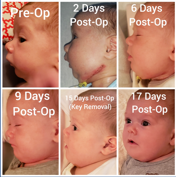 Before and After Mandibular Distraction for Micrognathia Associated with Difficulty Breathing.