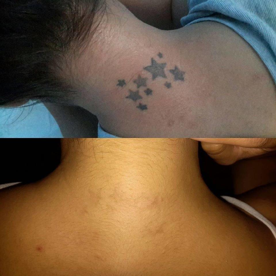 Winter Park Tattoo Removal Photo