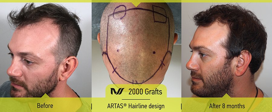 Amazing transformation following ARTAS robotic hair transplant surgery