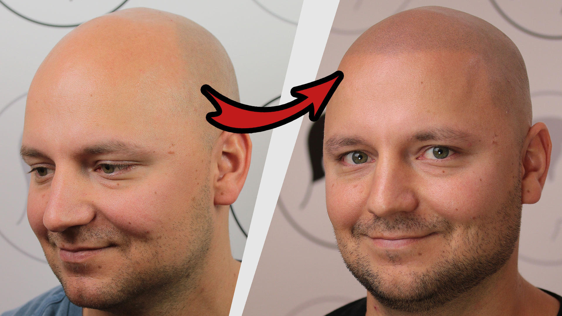 Kundenfoto 4 Haarpigmentierung | Modern Hair Loss Solution