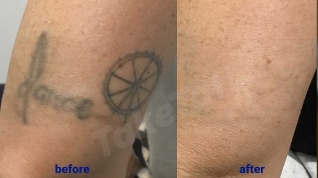 Images TakeTatt Tattoo Removal