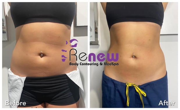 Images Renew Body Contouring & MedSpa