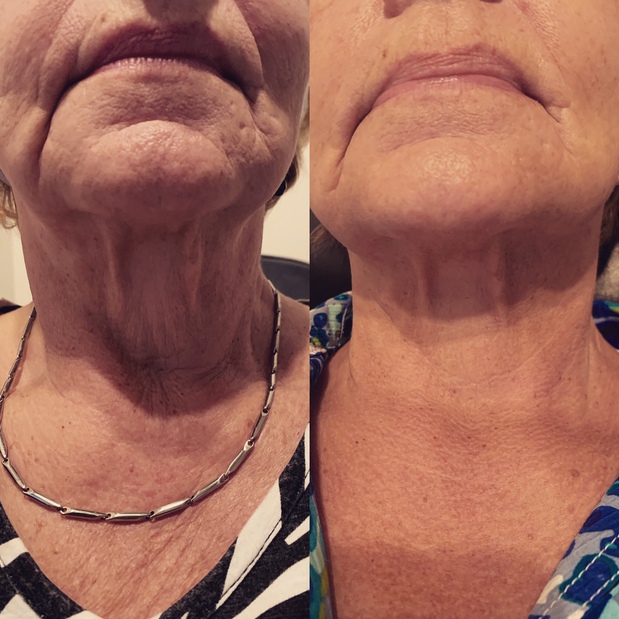 RF Microneedling- Tightens and reduces fine lines
407-622-2252 Wymore Laser