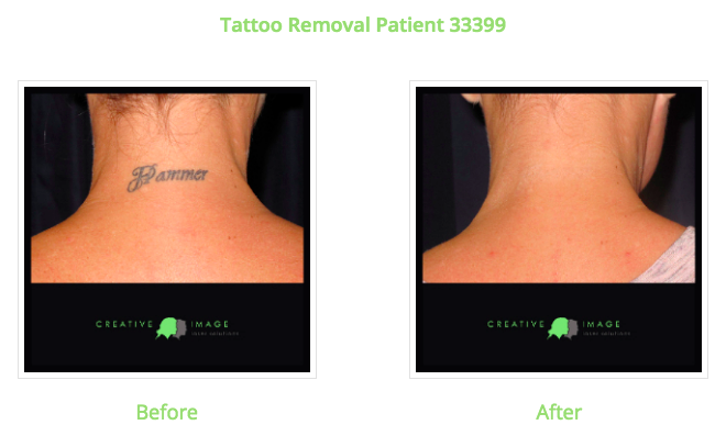 Tattoo Removal