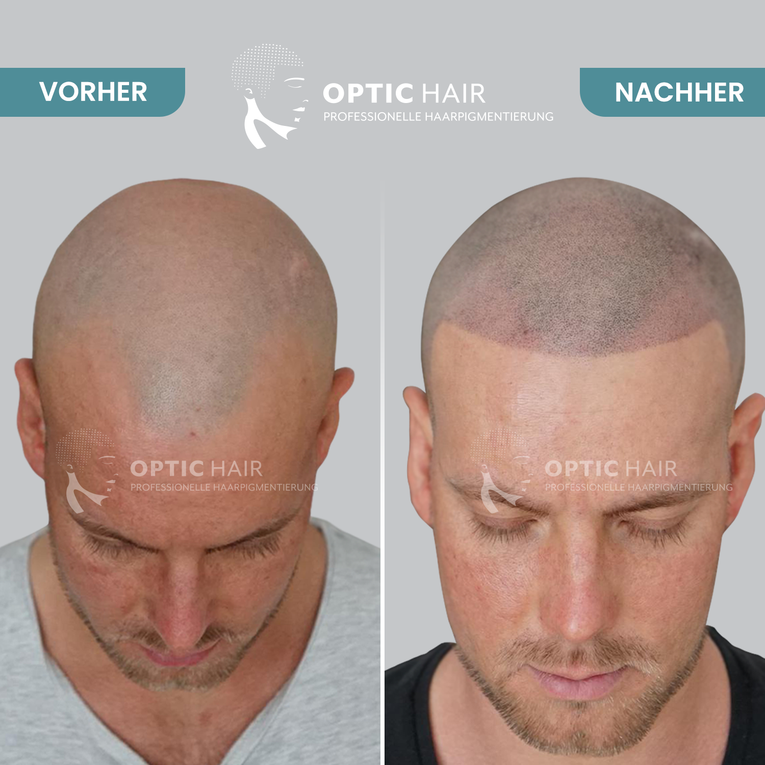 Kundenbild groß 20 Haarpigmentierung Köln | OpticHair