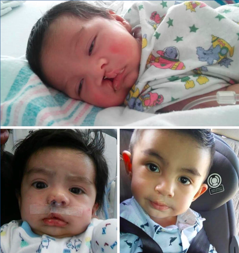 Before and After Unilateral Cleft Lip Repair