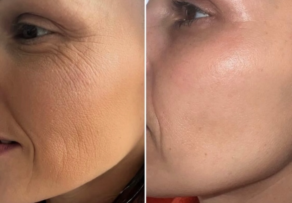 Lumi Eyes under-eye skin booster result at KWJ Skin Clinic, a professional aesthetic clinic in Horsham offering under-eye rejuvenation, skin boosters and advanced skin treatments.