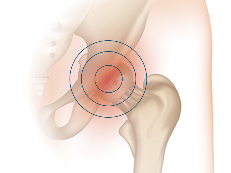 Cncrns_Cndtns-hippain-arthritis-392x294@2x.jpg