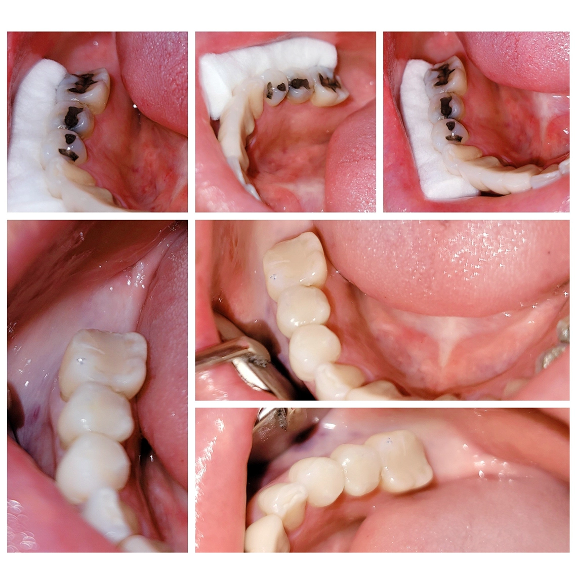 Marcos Torres Dental Esthetics- Coronas Dentales