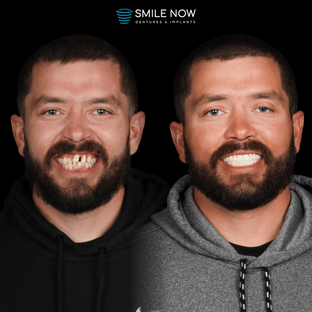 Images Smile Now Milwaukee Dentures and Implants
