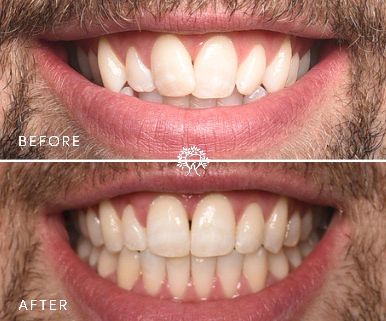 Images Taylor Street Dental: No.1 state-of-the-art Invisalign® | Cosmetic Dentist