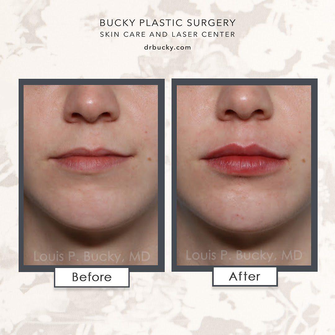 Patient before and after photos using 1ml of Juvederm Volbella in the upper and lower lips. Louis P. Bucky, MD, FACS Philadelphia (215)829-6320