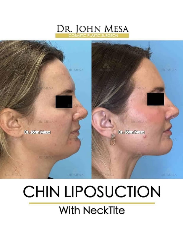 Images Dr. John Mesa, MD: Plastic Surgeon NYC, Buccal Fat Removal, Chin Liposuction, Facelift, Facial Masculinization, Chin Implant