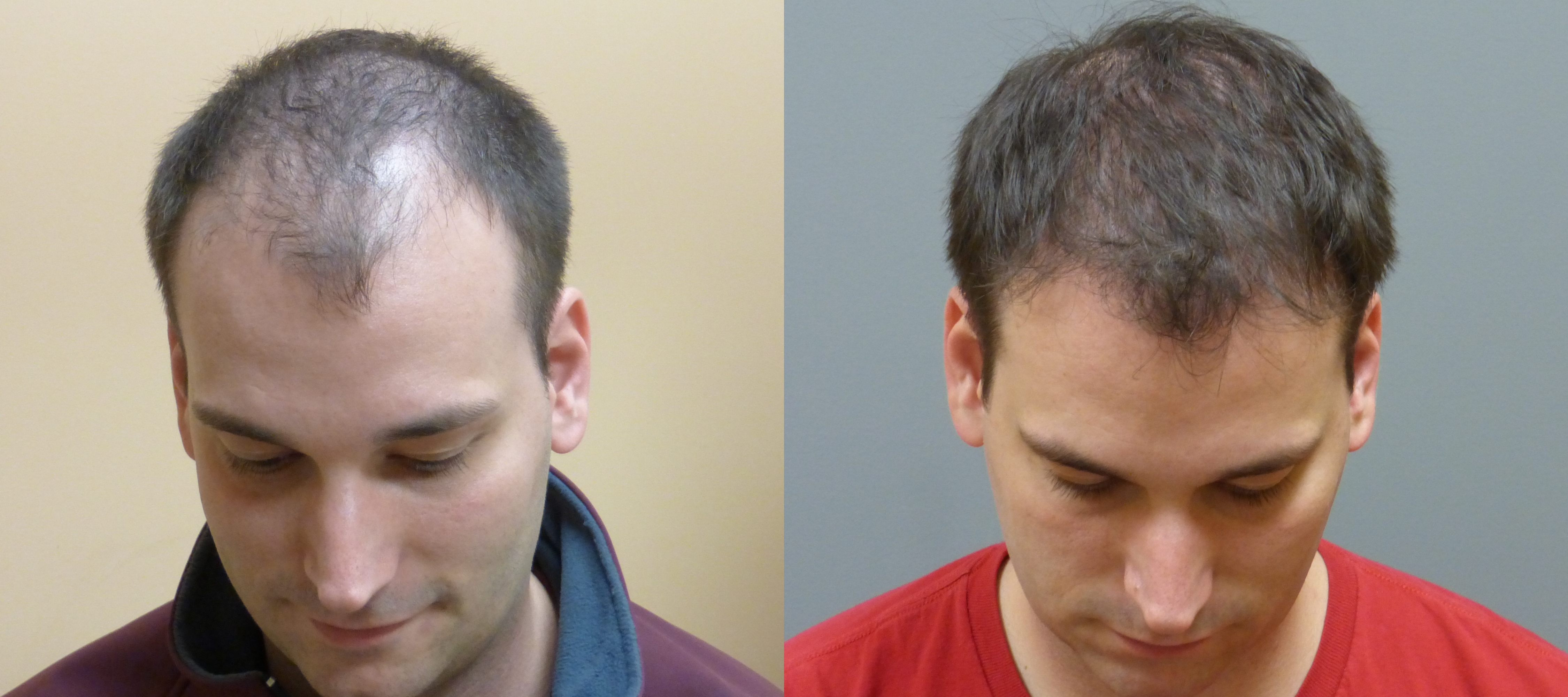 Before and 7 months after Neograft Hair Transplantation in Savannah. Photo copyrights Dr. E. Ronald  Hair Restoration Savannah Savannah (912)480-9913