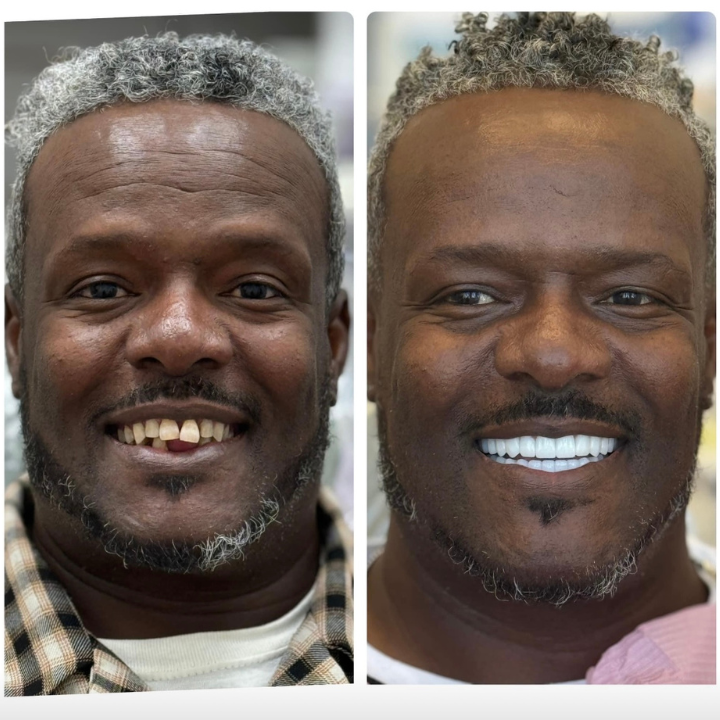 Before and After