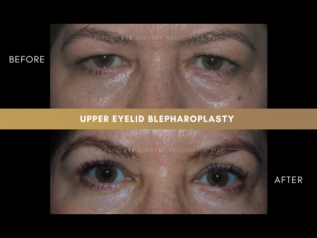 Images Plastic Eye Surgery Associates, PLLC