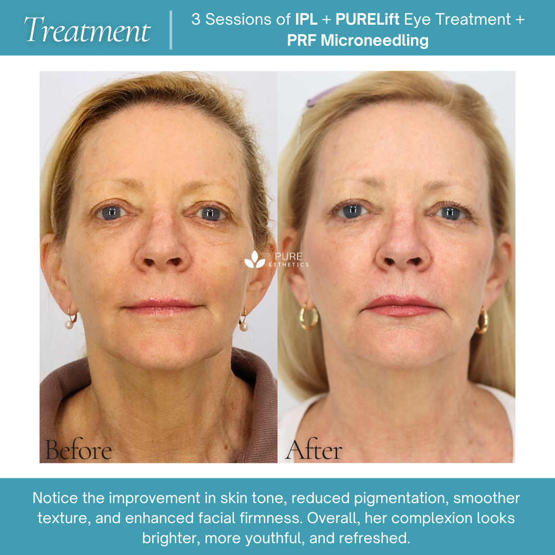 Before-and-after treatment results from Pureesthetics show a female client following three sessions of Intense Pulsed Light, PURELift eye treatment, and PRF microneedling. The comparison highlights brighter skin tone, reduced pigmentation, smoother texture, and improved facial firmness.