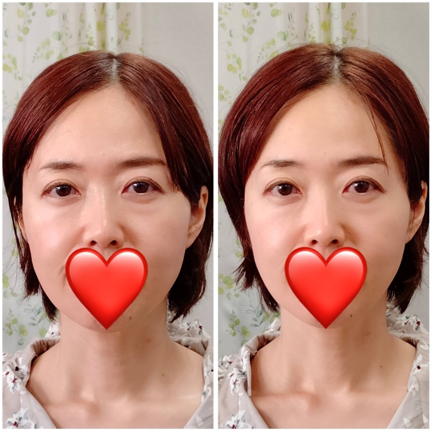 Images 目元・口元のたるみ&眉間シワ改善専門サロン