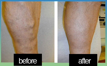 Image 5 | Laser Lipo and Vein Center