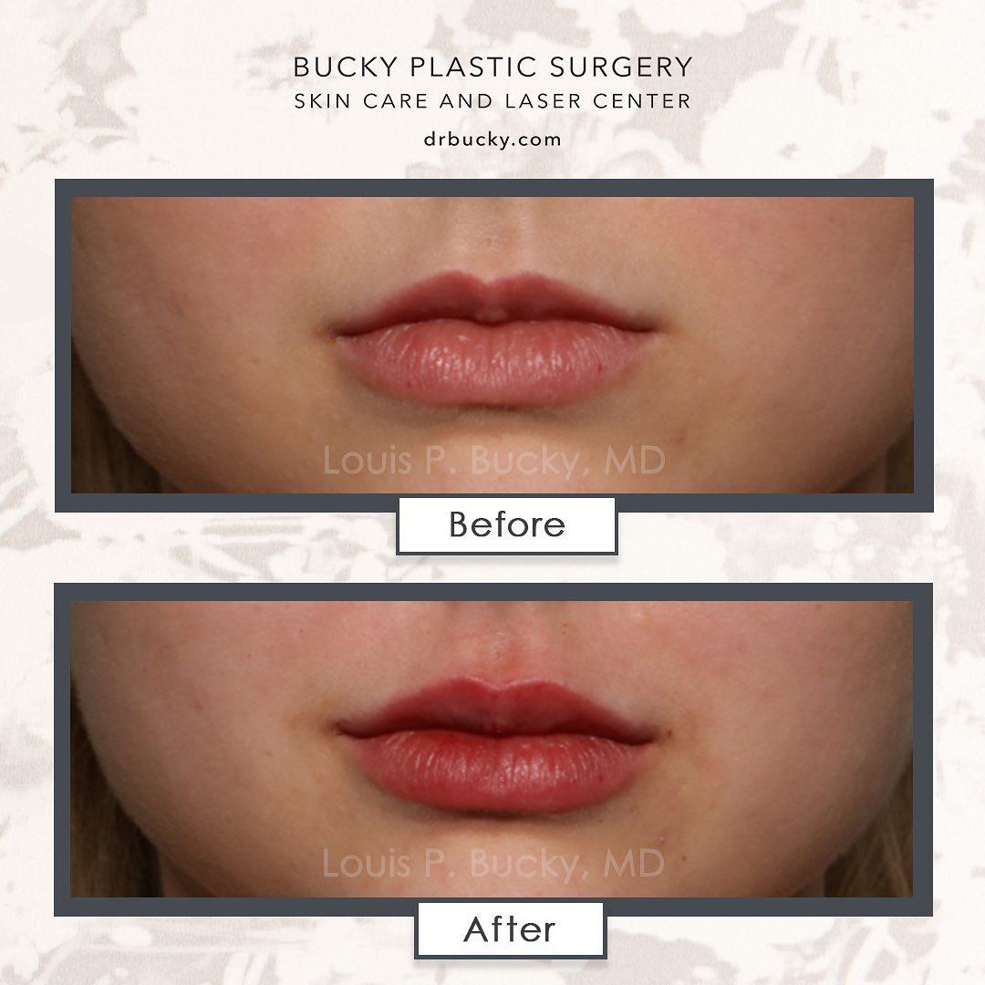 Patient before and after photos using Juvederm Ultra Plus. Louis P. Bucky, MD, FACS Philadelphia (215)829-6320