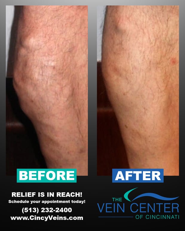 Images The Vein Center of Cincinnati, LLC
