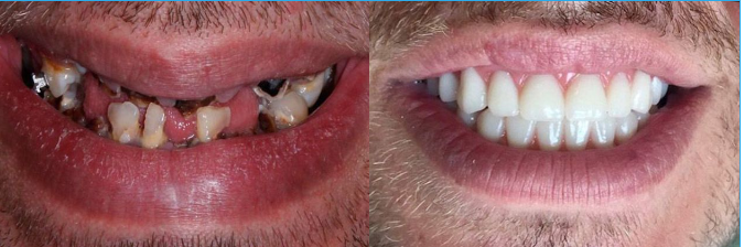 Before & After Results for Koyfman Dental | Orlando, FL