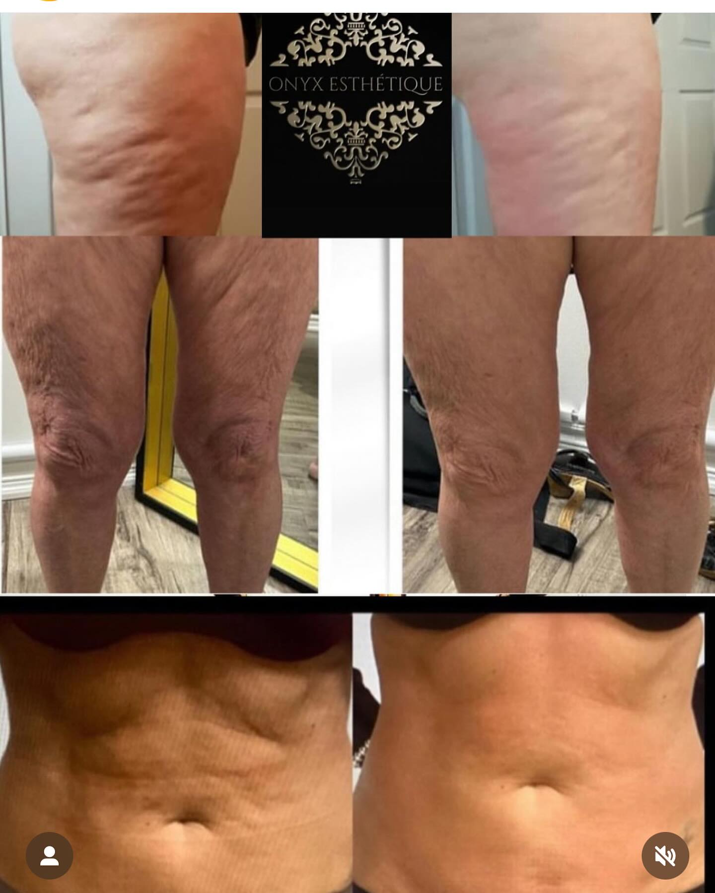 Images Onyx Esthétique - Soins esthétiques, Soins de la peau, Laser Cynosure Gatineau