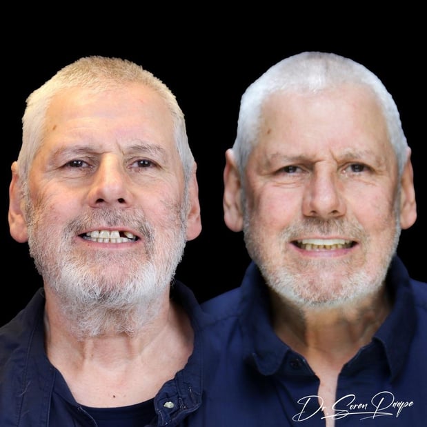 Images Smile Now Denver Dentures and Implants