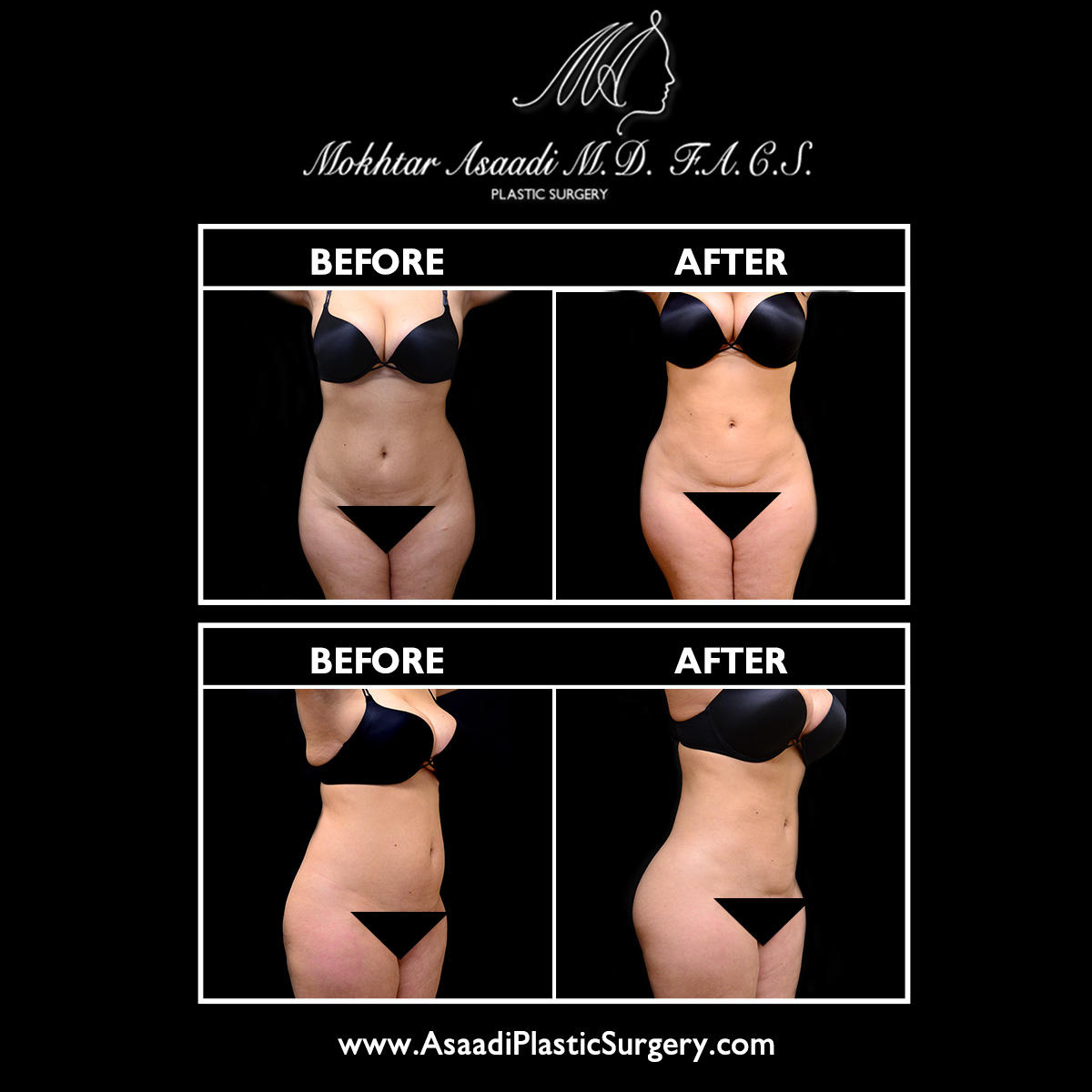 Liposuction in NJ can create awe-inspiring results. In this case, Dr. Asaadi performed liposuction of the abdomen, flanks, and back.