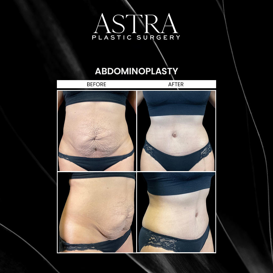 Tummy tuck surgery, also known as abdominoplasty, firms and tightens the abdomen by addressing weakened abdominal muscles, extra fat, and loose skin in the midsection. By eliminating excess skin and fat, patients undergoing tummy tuck surgery can achieve a more sculpted and toned stomach.