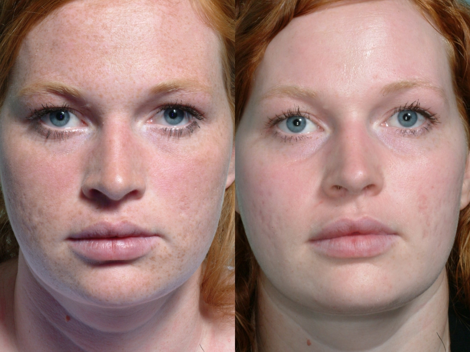 TCA Peel for sun damaged skin and freckles