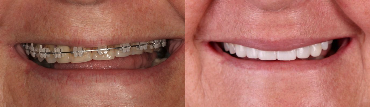 Crowns Before & After at Schmitt Prosthodontics | Altamonte Springs, FL