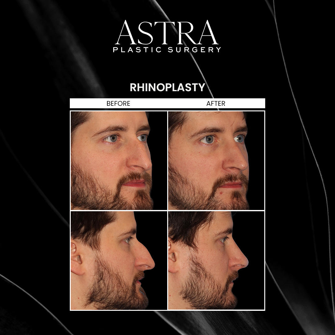 Rhinoplasty is a facial plastic surgery procedure that can address asymmetries of the nose and correct proportions. Nose reshaping is often sought after for cosmetic reasons, such as decreasing the size of the nose, reducing the appearance of dorsum humps, lifting the nasal tip, widening a flat nasal bridge, and more. A nose job can also be performed to correct functional issues, such as breathing difficulties due to a deviated septum.