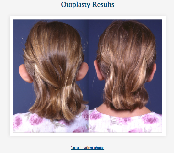 Otoplasty Before & After at Clinic of Facial Plastic Surgery | Buffalo, NY