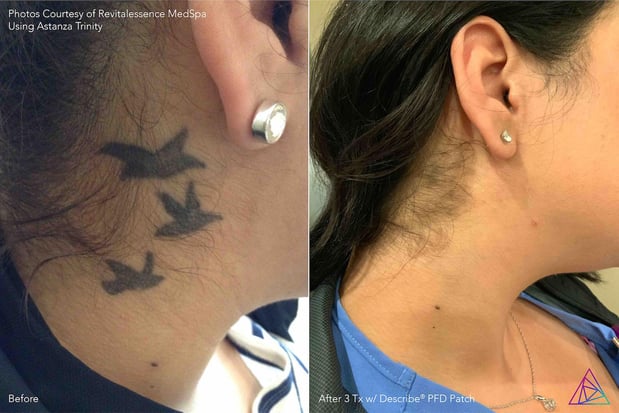 Images Integrity Ink - Laser Tattoo Removal in Crosby, TX