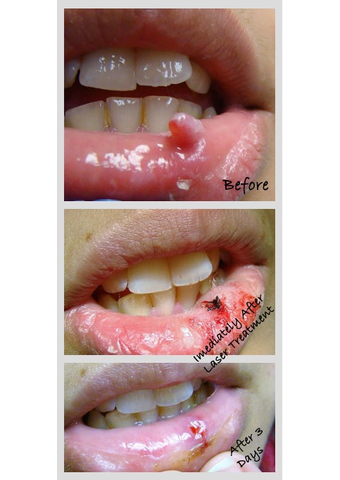 Before-and-after dental laser treatment showing the treatment area before the procedure, immediately 