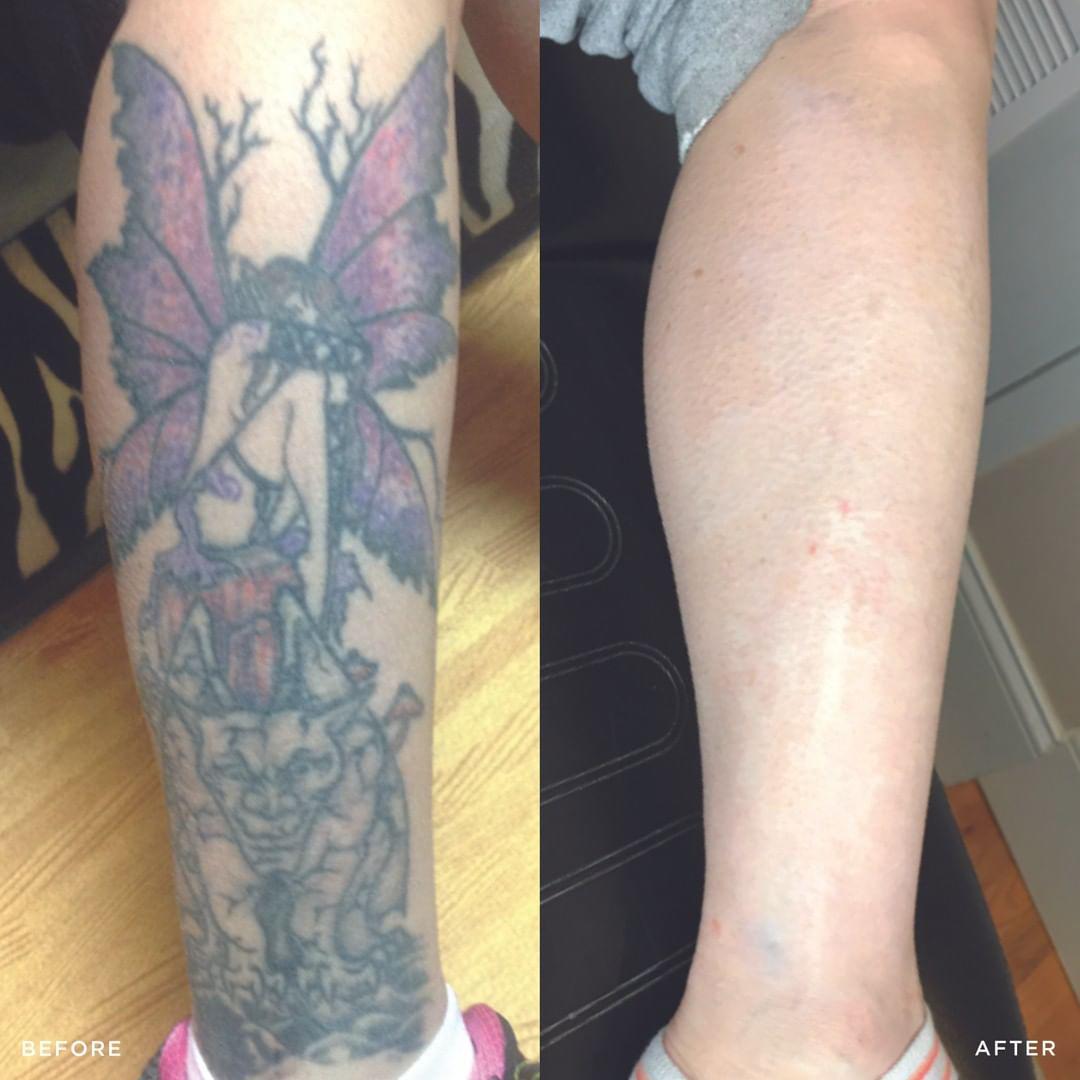 Removery Tattoo Removal & Fading à Ottawa: Before & After Calf Tattoo Removal