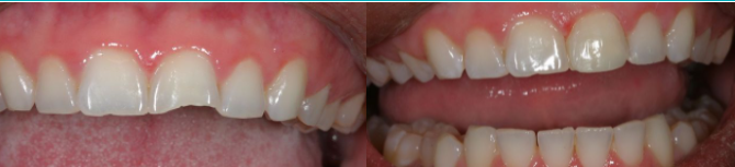 Before & After Results at The Office of Keith G. Lorio, DDS| Baton Rouge, LA