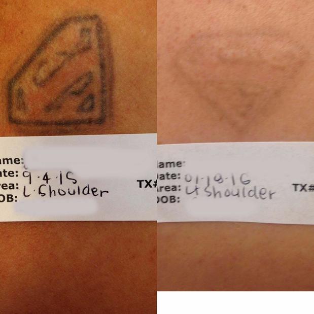 Images Inklifters Tattoo Removal