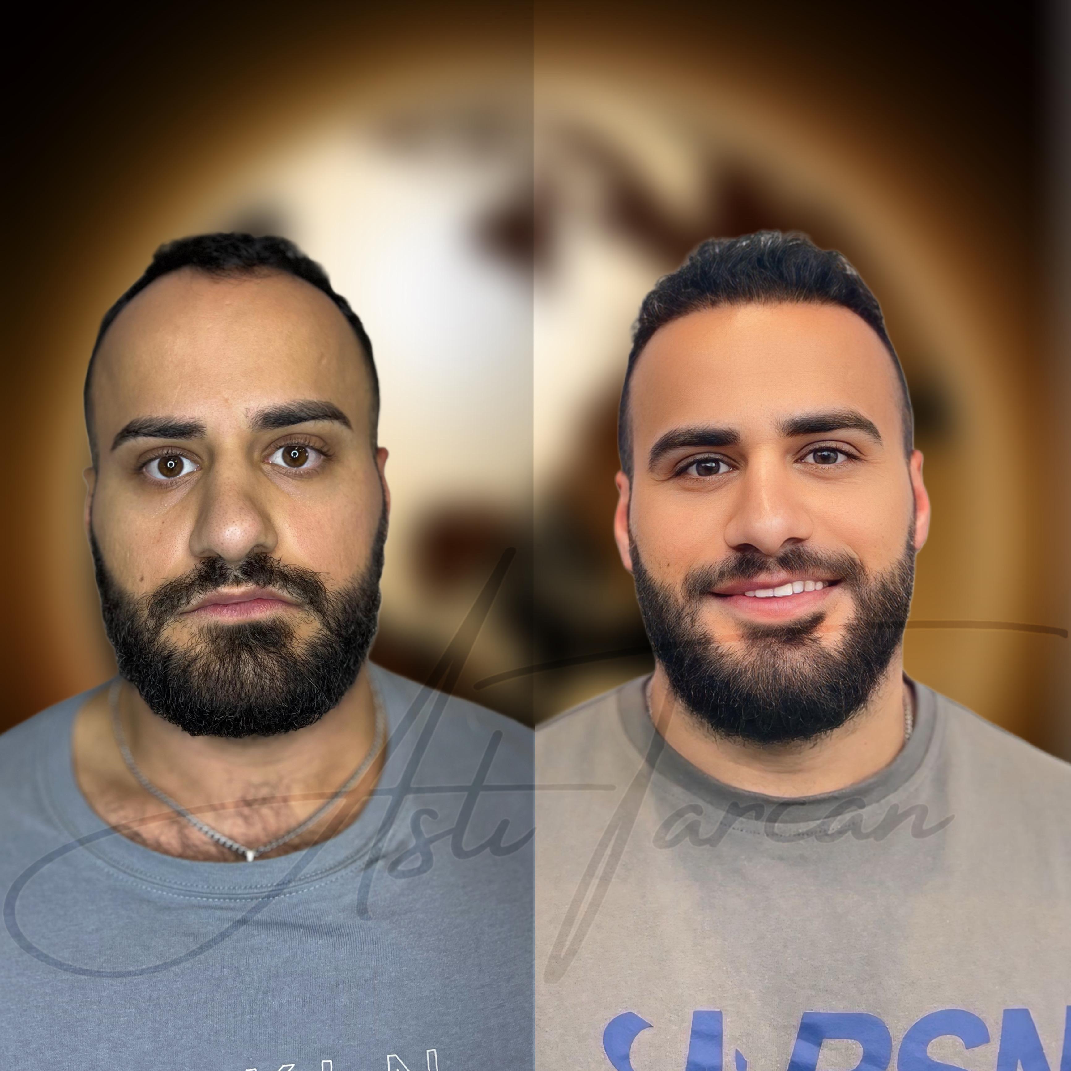 Bild 7 Asli Tarcan Clinic | Haartransplantationen in der Türkei Istanbul in Köln