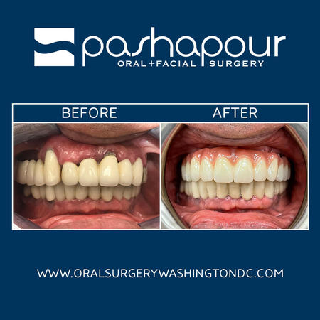 Dental implants provide long-lasting results for patients that seek to transform their smile. This patient had a loose bridge and was experiencing pain on his front teeth. In one day, we provided dental implants, bone grafted the various sites, & provided a full mouth reconstruction.