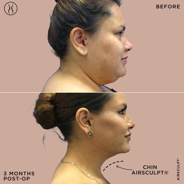 Images AirSculpt - Boston