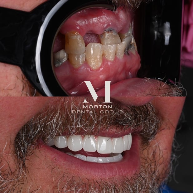 Images Nashville Wisdom Teeth and Implant Solutions